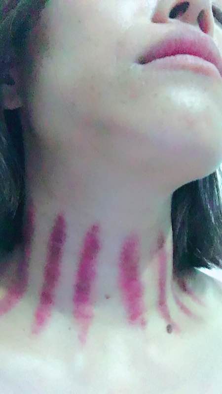 揪痧之美，最新时尚潮流相册分享，领略揪痧的独特魅力